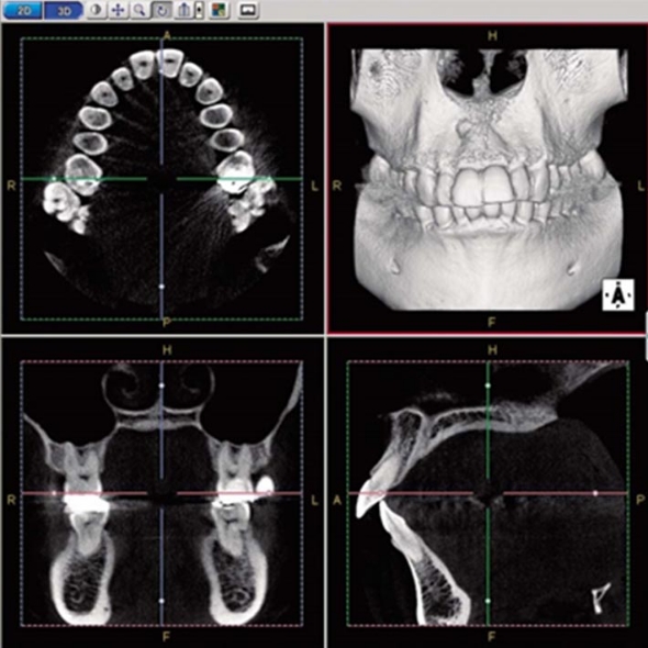歯科用CTレントゲン写真